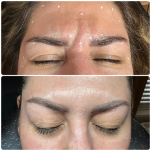 Before After Dysport