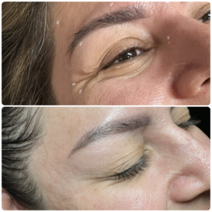 Before After Dysport Crow's Feet