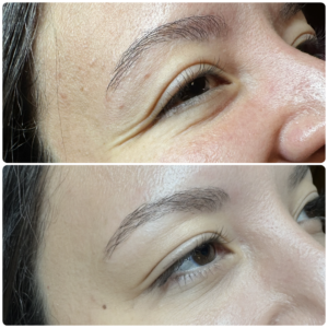 Before After Letybo Crow's Feet