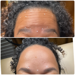 Before After Letybo Forehead